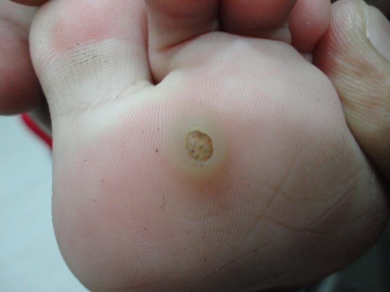 Plantar Warts (Foot Warts) Most Extensive Guide & Treatment Methods