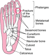 Broken Foot Symptoms